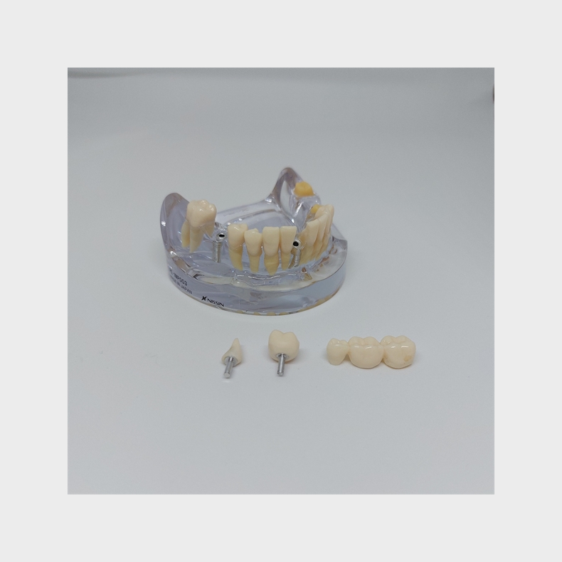 Implantat/Bro Studiemodel 